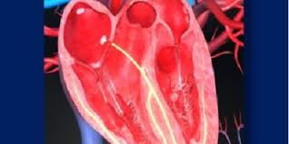 Image result for Lyme Carditis