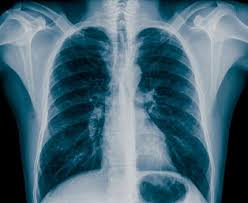 What Chest X Rays Tell Us About Asthma Patients Asthma Cure What Is Asthma Asthma