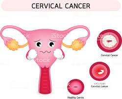 Cáncer in situ