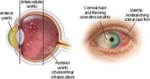 Image result for Uveitis