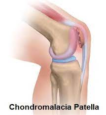 Chondromalacia Patella: Causes & Treatment - Knee Pain Explained
