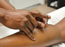 Image result for Acupuncture