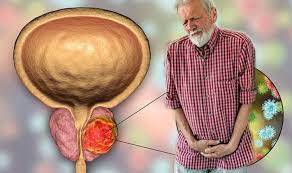 The prostate is a gland in the male reproductive system that surrounds the urethra just below the bladder. Prostate Cancer Symptoms The Difficulty When Going To The Toilet To Watch Out For Sound Health And Lasting Wealth