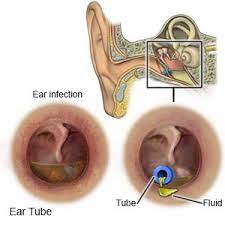 Eustachian Tube Dysfunction - What You Need To Know