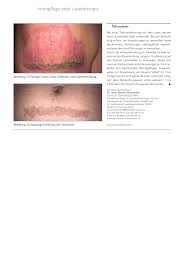 Hautpflege Nach Lasertherapie Rosenfluh Ch
