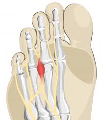 Morton's neuroma is a benign neuroma of an intermetatarsal plantar nerve, most commonly of the second and third intermetatarsal spaces (between the second/third and third/fourth metatarsal heads), which results in the entrapment of the affected nerve. Is There A Cure For Morton S Neuroma Of The Foot Hubert Lee Dpm Podiatrist