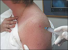 Image result for Subacromial Space Injection