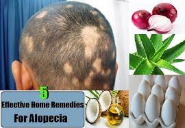 It is a disease correlated with the immune system. 5 Effective Home Remedies For Alopecia Hair Remedies For Growth Thick Hair Remedies Balding Remedies