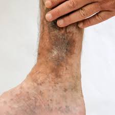 Image result for Pigment stains on the shin