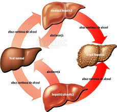 Ciroza hepatica reprezinta stadiul final de evolutie al tuturor hepatitelor cronice (inflamarea ficatului cu evolutie lenta si de durata) indiferent de etiologie (cauza). Ciroza Hepatica Alcoolica