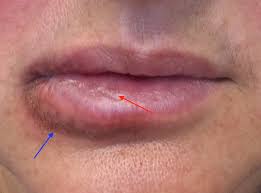 What is a clear bump on the inside of your lip? Recurrent Blisters On The Lip The Bmj