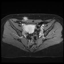 Ct stands for computed tomography. Scar Endometriosis Radiology Case Radiopaedia Org