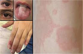 Jul 17, 2020 · she also showed symptoms suggestive of kawasaki, such as pink eye, cracked lips, swollen hands and feet, redness on the palms of her hands, a large rash and swollen lymph nodes. Paediatric Multisystem Inflammatory Syndrome Associated With Covid 19 Filling The Gap Between Myocarditis And Kawasaki Springerlink