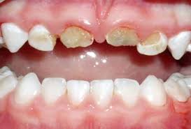 Baby Bottle Tooth Decay Known As Early Childhood Caries Ecc Is Decay On Upper Front Teeth Of Babies Dental Decay Baby Bottle Tooth Decay Dentistry For Kids