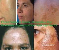 Treatment is not always necessary for melasma. Pin On Health And Beauty Care No Nudity No Spam