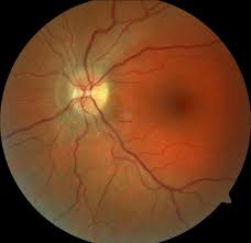 Image result for Optic Neuritis