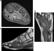 There can't be any metal in the room, not just where you have the mri. Wooden Splinter Induced Extremity Injuries Accuracy Of Mri Evaluation Sciencedirect