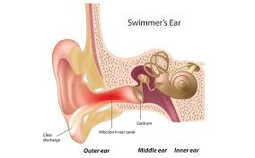 Image result for Inner Ear Decompression Sickness
