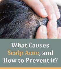 This gel works with all types, but it's especially loved by those with straight. What Causes Scalp Acne And How To Prevent It Scalp Acne Hypoallergenic Hair Care Acne