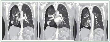 Endometriosis can affect women of any age. Catamenial Pneumothorax A Rare Entity Report Of 5 Cases And Review Of The Literature Visouli Journal Of Thoracic Disease