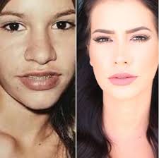 \r\reste cara imita vários cantores sertanejos famosos, como leandro, eduardo. Adriana Sant Anna Mostra Antes E Depois De Cirurgias No Nariz Tenha Esperanca Jetss