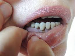 Salty Taste In Mouth Causes Treatment And When To See A Doctor