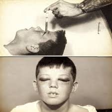 Lobotomy used to cure homosexuality
