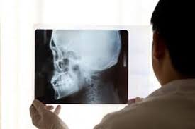 Hal itu karena sendi pelana adalah sendi yang dalam pergerakannya bisa bergerak ke dua arah. Benjolan Di Rahang Waspadai Tumor
