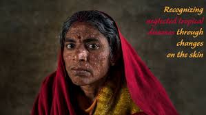 Recognizing neglected skin diseases: WHO publishes pictorial training guide 