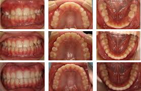 そして、出っ歯が治っていないのに 矯正治療の終了 を告げられました。 元々、この歯並びだったら何も思っていなかったかもしれません。 だけど、70万円という高額の矯正治療費を支払って、2年間の矯正生活を送ったにも関わらず、綺麗な歯並びに. å­ã©ãã®åºã£æ­¯ã®æ­¯ä¸¦ã³ç¯æ­£æ²»ç æ±äº¬é½æ¸¯åºéº»å¸åçªã®ucç¯æ­£æ­¯ç§'
