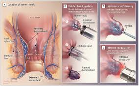 Image result for Hemorrhoid