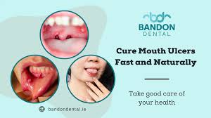 Image result for mouth ulcer on tongue)
