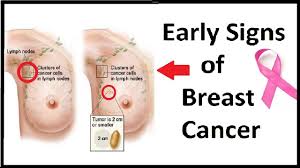 Certain changes in the breast may be early signs of breast cancer. Warning Signs Of Breast Cancer Faculty Of Medicine