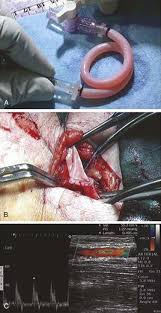 Zarkowsky, jahan mohebali, mark r. Prosthetic Grafts Thoracic Key