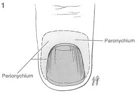 Image result for paronychium