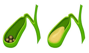 If you're used to eating a lot of meat, a gallbladder removal diet can seem intimidating. Life After Gall Bladder Removal Health Plus