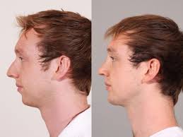 Open Rhinoplasty And Chin Implant Barker Plastic Surgery