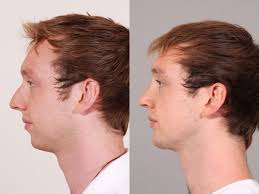 open rhinoplasty and chin implant barker plastic surgery