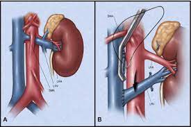 Left Renal Vein Transposition For Nutcracker Syndrome Journal Of Vascular Surgery