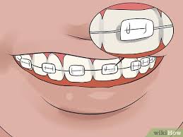 How to get whiter teeth with braces fast. 3 Ways To Whiten Your Teeth When You Have Braces Wikihow