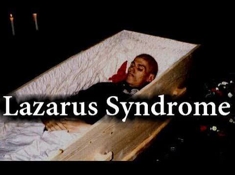 "Lazarus Syndrome"