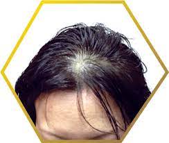 The result is often a reduction in the number of hair follicles altogether, or decreased size and quality of the follicles, resulting in finer and coarser hair growth. Post Menopausal Hair Loss Causes Treatment
