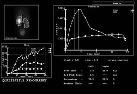 A Pelvi Ureteric Junction Puj Obstruction Can Be One Of The Causes Of An Obstructive Uropathy It Can Be Congenital Or Acquire Nuclear Medicine Radiology Puj