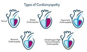 Image result for Cardiomyopathy