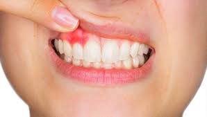 Ada kalanya, sampai lebih sakit dari sakit gigi bukan? 10 Punca Gusi Bengkak Yang Pasti Buatkan Anda Terkejut Bidadari My