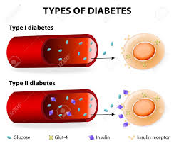 Diagnosed with type 2 diabetes? Types Of Diabetes Type 1 And Type 2 Diabetes Mellitus Insulin Dependent Royalty Free Cliparts Vectors And Stock Illustration Image 27551990