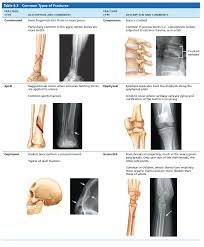 Table Illustrates And Describes Common Fractures Types And The Image For A Spiral Fracture Shows A Diagonal Fract Spiral Fracture Types Of Fractures Fractures