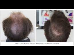 Can I Get A Full Head Of Hair From A Hair Transplant Hair Density Hair Hair Transplant
