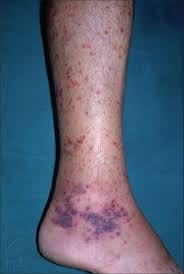 The most striking feature of this form of vasculitis is a purplish rash, typically on the lower legs and buttocks. Indian Journal Of Dermatology Venereology And Leprology Adult Henoch Schonlein Purpura Clinical And Histopathological Predictors Of Systemic Disease And Profound Renal Disease