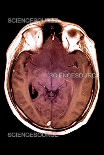 Coma (brain-dead), MRI scan | Stock Image - Science Source Images